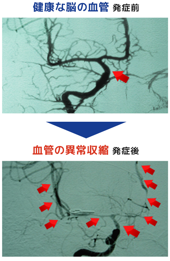 血管の異常収縮発症前後の様子